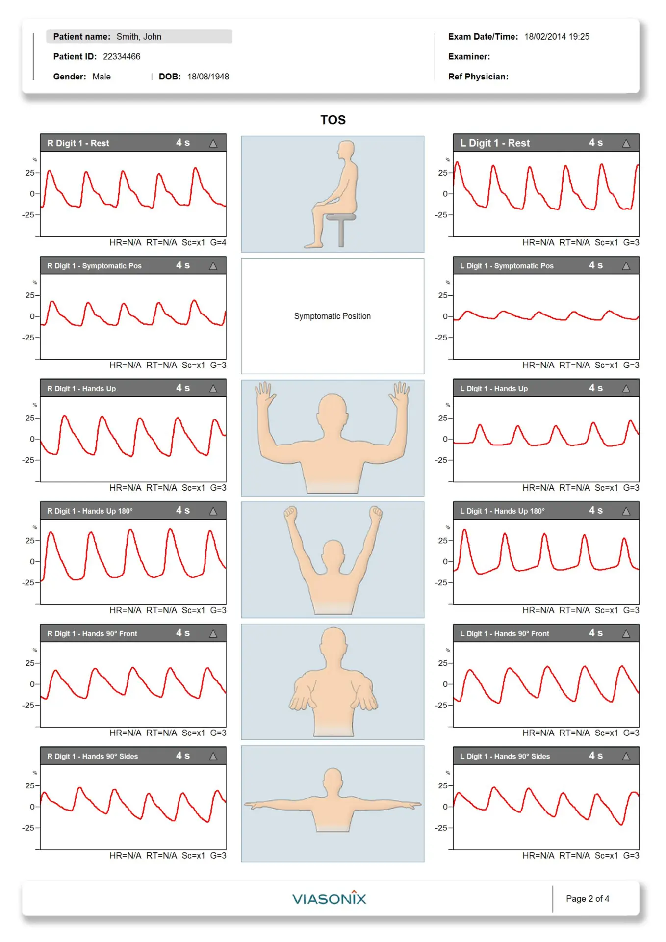 Sample Thoracic Outlet Syndrome and Palmar Arch Test 2