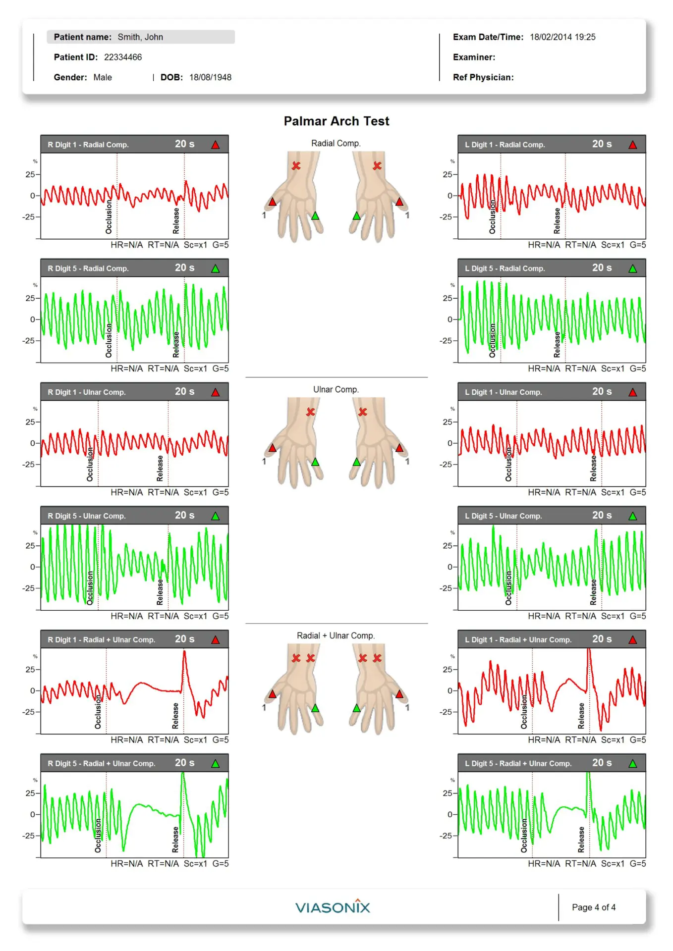 Sample Thoracic Outlet Syndrome and Palmar Arch Test 4