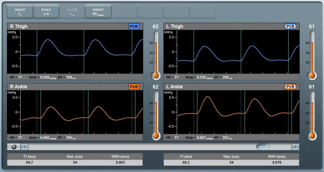 falcon-pulse-wave-velocity-pwv-results-screen